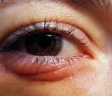 Images of Swollen Bottom Eyelid Home Remedies