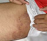Photos of Thigh Pimples Home Remedies