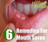 Celiac Mouth Sores Treatment Pictures