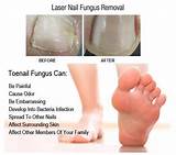 Do Laser Treatments For Toenail Fungus Work Pictures
