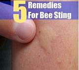 Pictures of How To Cure A Bee Sting Home Remedies
