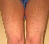 Images of Latest Treatment For Spider Veins