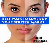 Can Makeup Cover Up Stretch Marks Photos