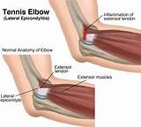 Images of Wrist Tendon Injury Recovery Time