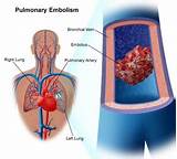 Medical Treatment For Pulmonary Embolism Photos