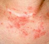 Images of Contact Eczema Treatment