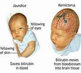 Pictures of Jaundice Symptoms And Treatment