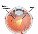 Images of Retinal Detachment Surgery Gas Bubble