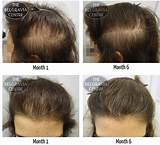 Female Pattern Baldness Treatment Pictures