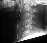 Cervical Spine Fracture Treatment Images