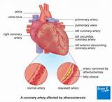 Images of What Can Cause Coronary Artery Disease