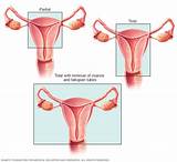 Partial Hysterectomy Side Effects Mayo Clinic
