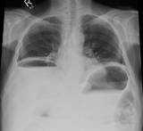 Signs Of Gas In Chest Images