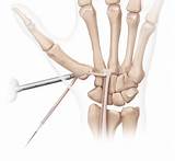 Thumb Arthroplasty Recovery Photos