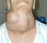 Images of Recovery After Thyroidectomy