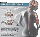 Symptoms Of Motor Neuron Disease Mayo Clinic Pictures