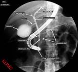 Images of What Is A Ercp Medical Procedure