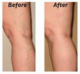 Can Acupuncture Help Varicose Veins Photos
