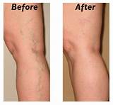 Spider Vein Treatment Before And After Pictures