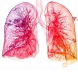 Images of Home Remedies For Interstitial Lung Disease