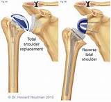 Photos of Shoulder Replacement Recovery