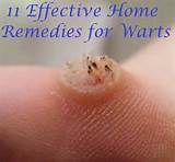 Seed Wart Removal Home Remedies Images