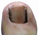 Ingrown Toenail Surgery Recovery Pictures