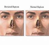 Pictures of Recovery After Deviated Septum Surgery