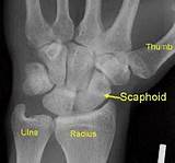 Photos of Scaphoid Fracture Treatment Options