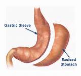 Gas After Gastric Sleeve Photos