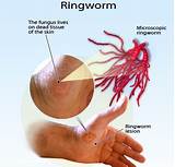 Photos of Ringworms Home Remedies