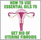Pictures of Fibroids And Gas