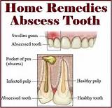 Home Remedies For Dental Abscesses