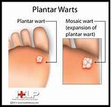 Wart Removal Doctor Cost Pictures