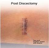 Pictures of Recovery From Slipped Disc Surgery