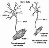 Symptoms Of Motor Neuron Disease Mayo Clinic Pictures