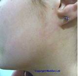 Laser Treatment For Facial Hair Removal Side Effects Photos