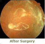 Retinal Detachment Surgery Gas Bubble Images