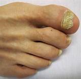Images of Pink Toenails Medical Condition