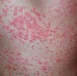 Photos of Guttate Psoriasis Home Remedies