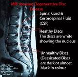Chiropractic Treatment For Bulging Disc In Lower Back Photos