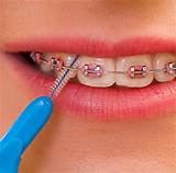 Is Electric Toothbrush Better For Braces Images