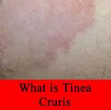 Tinea Corporis Home Remedies Images