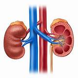 Pictures of Kidney Stone Removal Medical Term