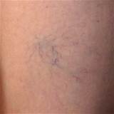 Early Varicose Veins Treatment