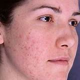 Acne Spot Removal Naturally Pictures