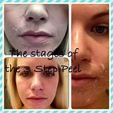 Pictures of Zo Chemical Peel