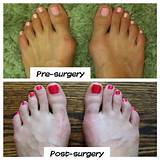 Photos of Foot Surgery For Bunions Recovery