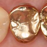 Images of Dental Gold Crown