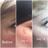 Sun Spot Removal Laser Pictures
